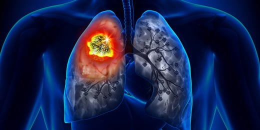 Illustration of lung cancer